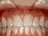Open Bite Springfield NJ | Springfield Orthodontics