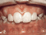 Protruding Front Teeth Springfield NJ | Springfield Orthodontics 