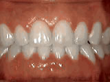 Spacing of Teeth Springfield NJ | Springfield Orthodontics